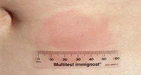 Rötung nach Mistelinjektion